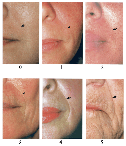 sculptra treatment dermal fillers stimulates collagen production dermal filler hyaluronic acid topical anesthetic sculptra injection up to two years sculptra stimulates cosmetic injection brazilian butt lift treatment area three treatment sessions