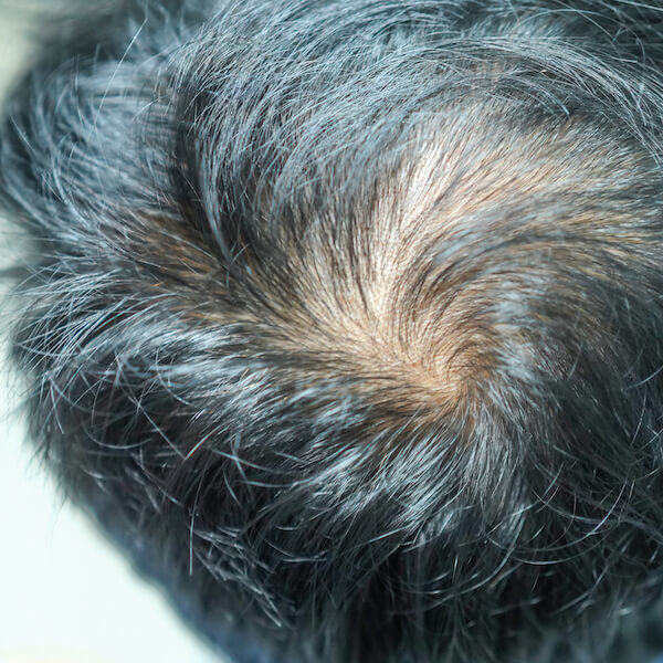 hair growth hair loss platelet rich plasma hair transplant prp therapy hair restoration hair loss treatment red blood cells platelet rich plasma treatment medical treatments alopecia areata female pattern baldness prp for hair loss hair transplants own body most patients new hair