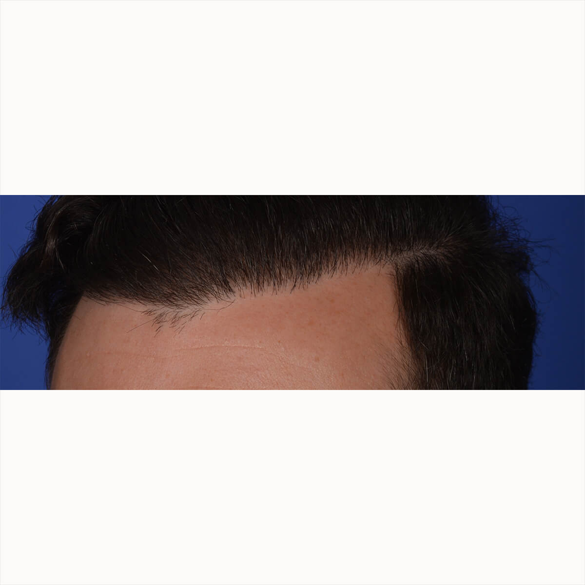thicker head own hair most patients hair restoration options