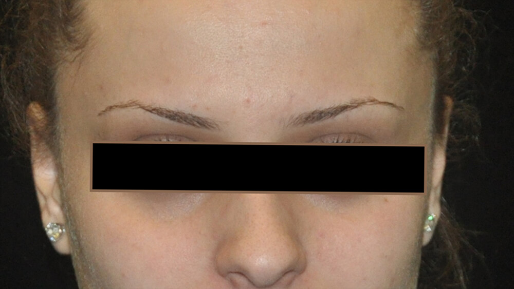 eyebrow transplantation naturally thin eyebrows transplanted hairs natural hair loss congenital absence natural shape removed hairs beverly hills watch dr one surgery recovery period desired density