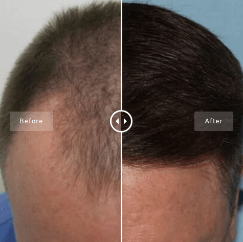 smartgraft hair loss hair restoration surgery