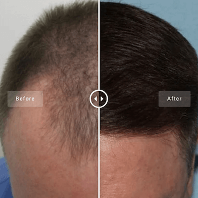 minimally invasive procedure comfortable procedure positive result hair restoration